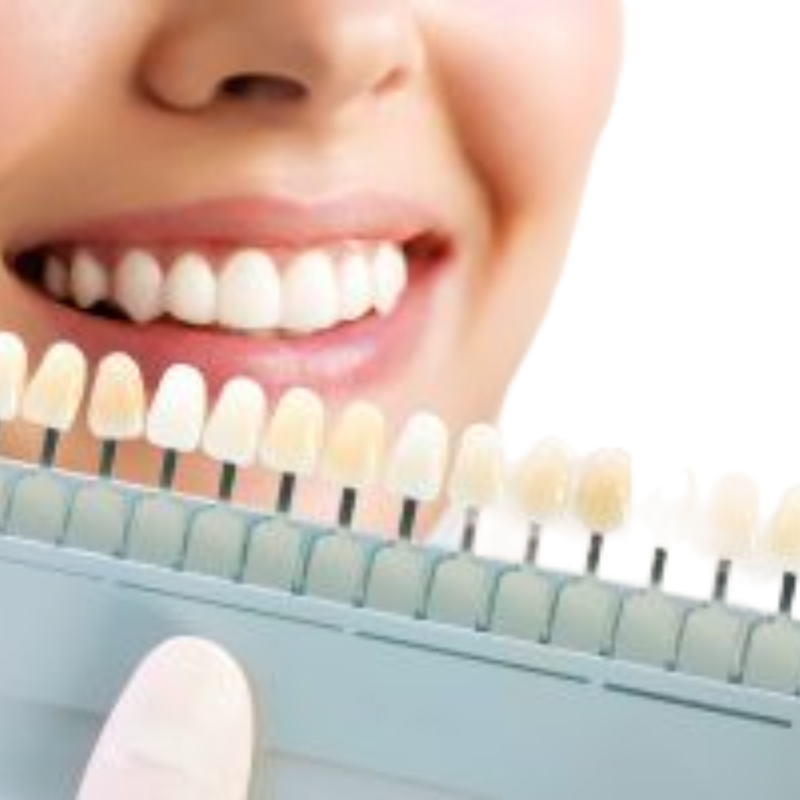 Blanqueamiento Dental